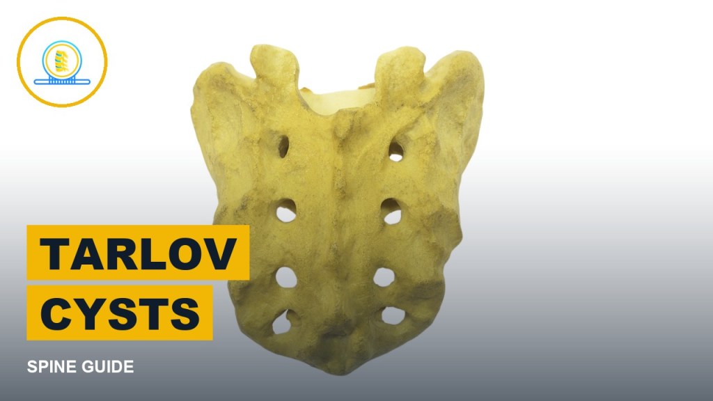 Tarlov cysts guide