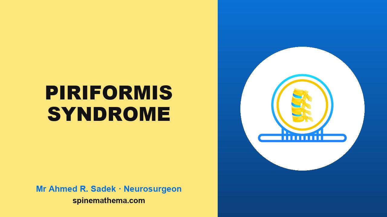 Piriformis syndrome video thumbnail