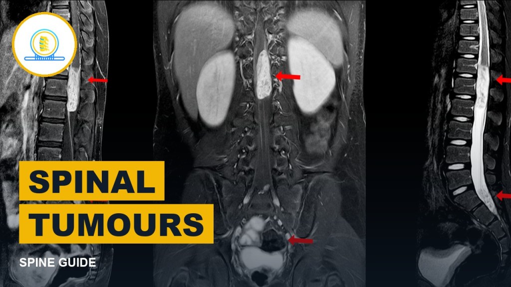 Spinal Tumours: Symptoms, Tests and Treatment