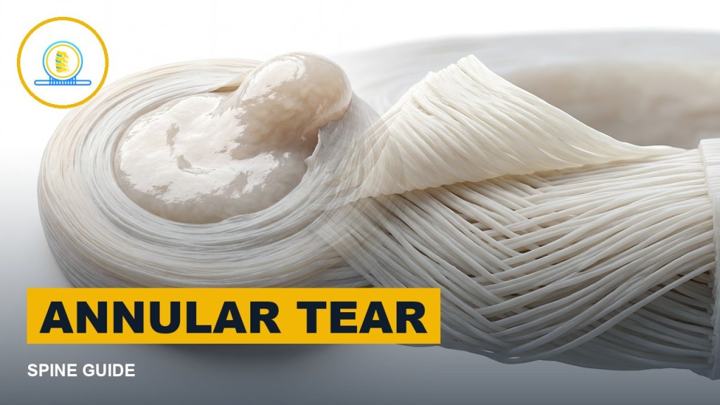 Annular tear picture